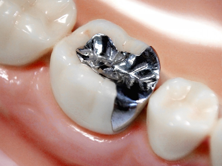 保険の銀歯が虫歯になりやすい理由