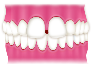 前歯のすき間が気になる・前歯の矯正をお考えの方