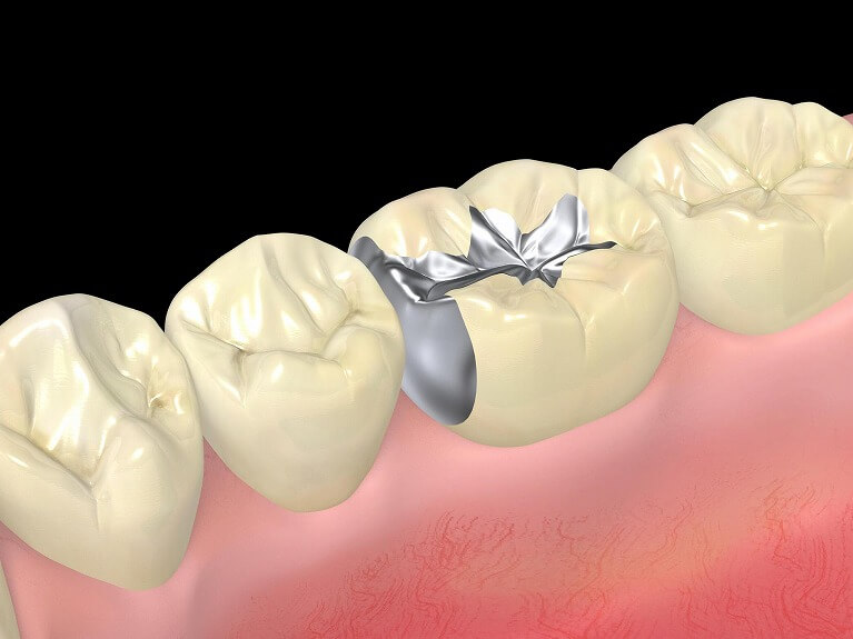 虫歯になりやすいだけではない銀歯のデメリット