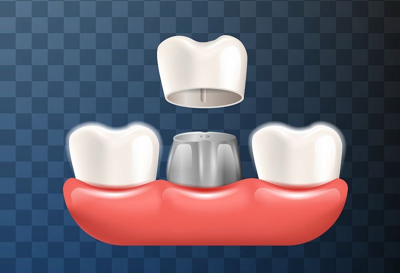 差し歯の金属と歯茎の黒ずみの関係