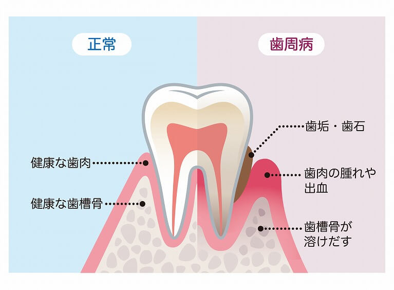 歯周病とは ？