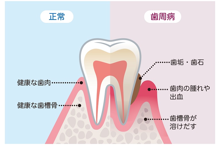 歯周病治療