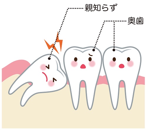 料金 親知らず 抜く