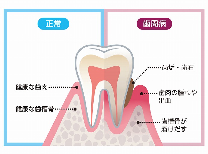 不良補綴物は虫歯や歯周病を発症・進行させる原因になる？