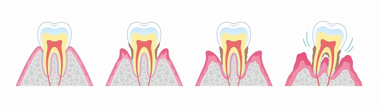 不良補綴物が歯周病を引き起こす理由